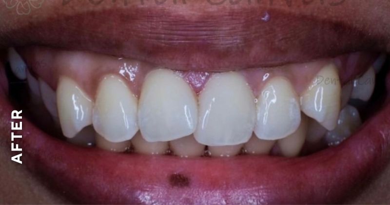 Anterior-Cavity-filling-after