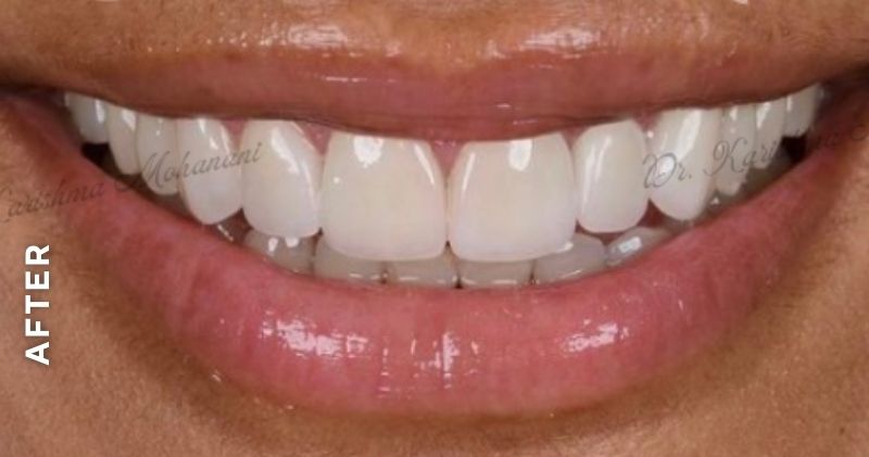 Anterior-veneer-after