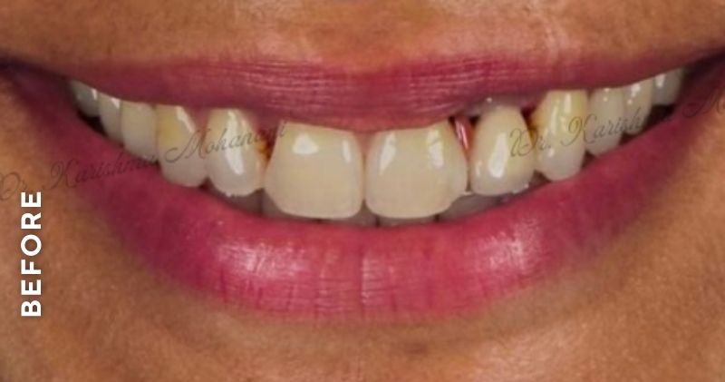 Anterior-veneer-before