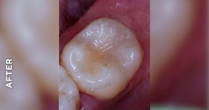 Cavity-Filling-after