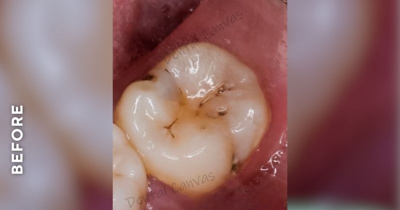 Cavity-Filling-before