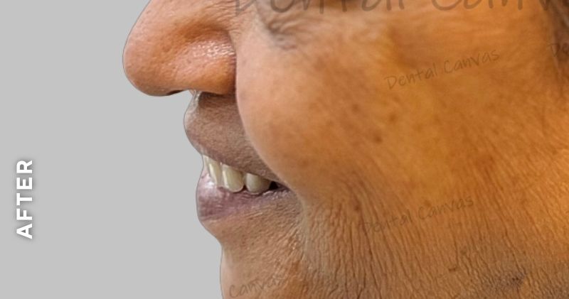 Complete-denture-after