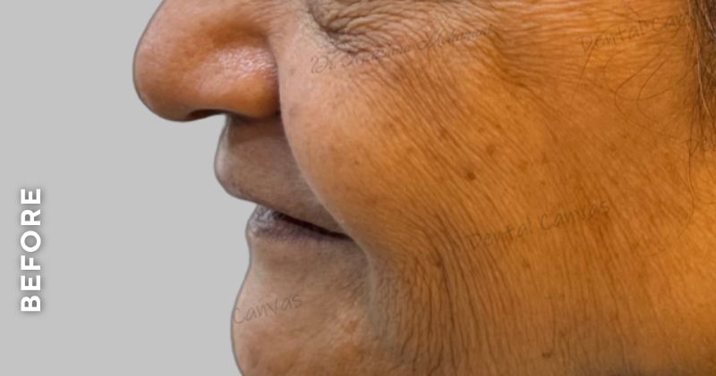 Complete-denture-before