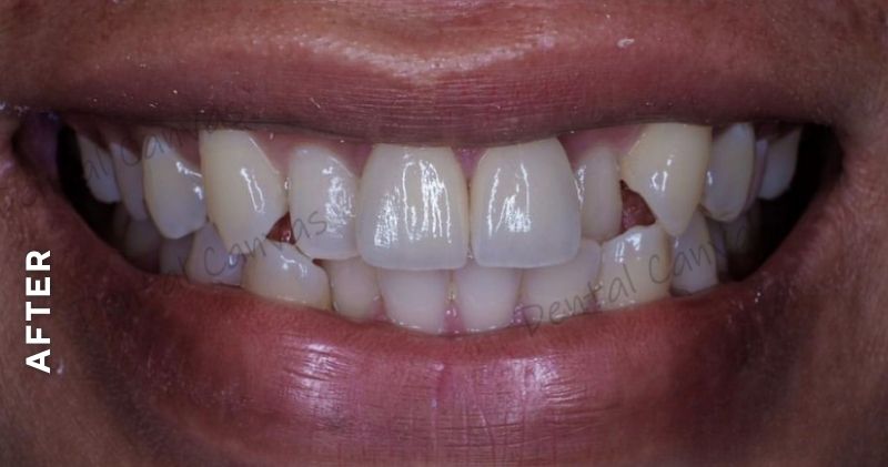 Dental-Veneers-after