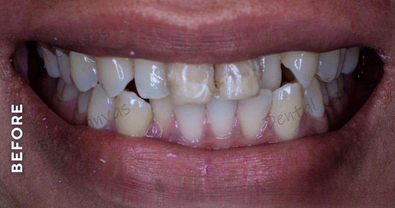 Dental-Veneers-before