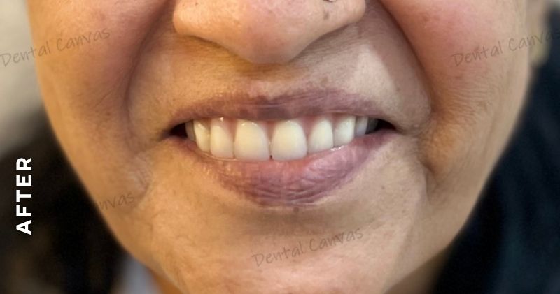 Denture2-after