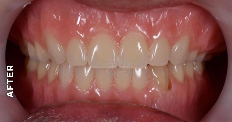 Complete-denture-after