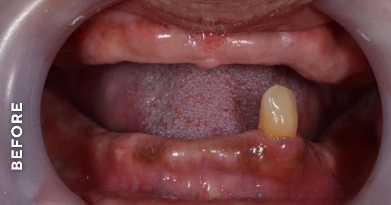 Complete-denture-before