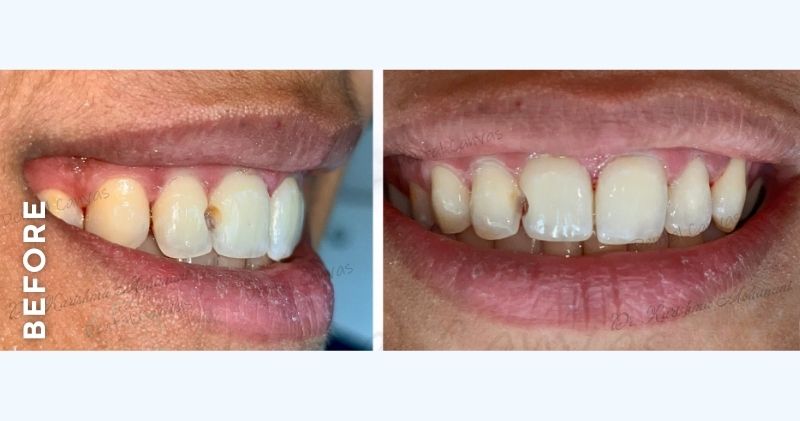 Front-Tooth-Cavity-filling-before