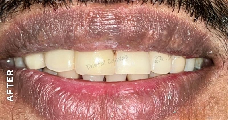 Missing Teeth Replacement