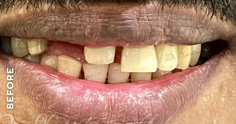 Missing Teeth Replacement