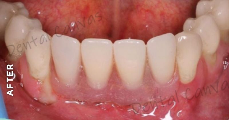 Partial-Denture-after