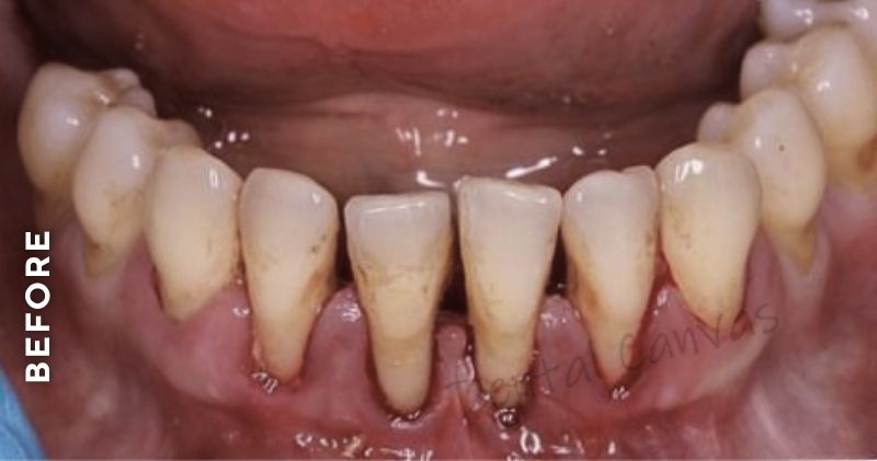 Partial-Denture-before