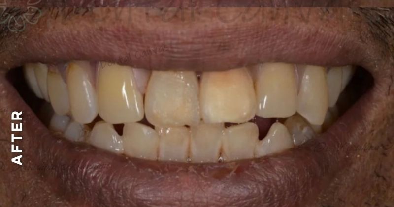 Removable-Partial-Denture-after