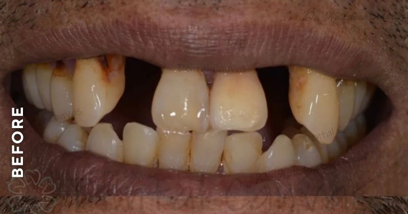 Removable-Partial-Denture-before
