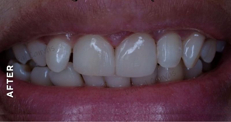 Partial-Denture-after