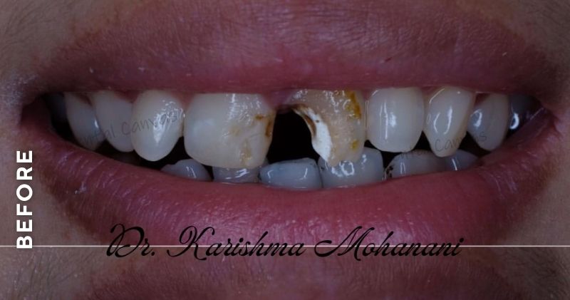 Partial-Denture-before