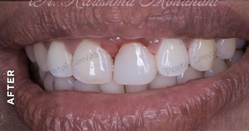 Smile-Makeover-after