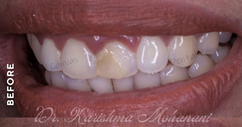 Smile-Makeover-before