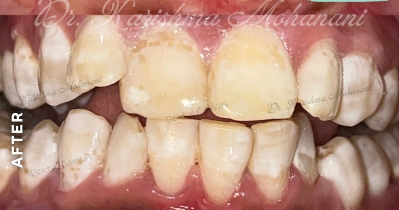 Teeth-Cleaning-after