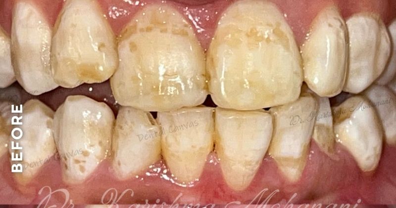 Teeth-Cleaning-before