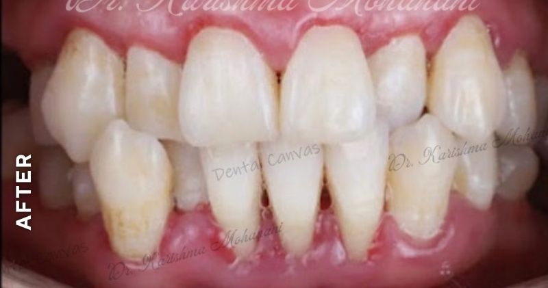 Teeth-Cleaning2-after