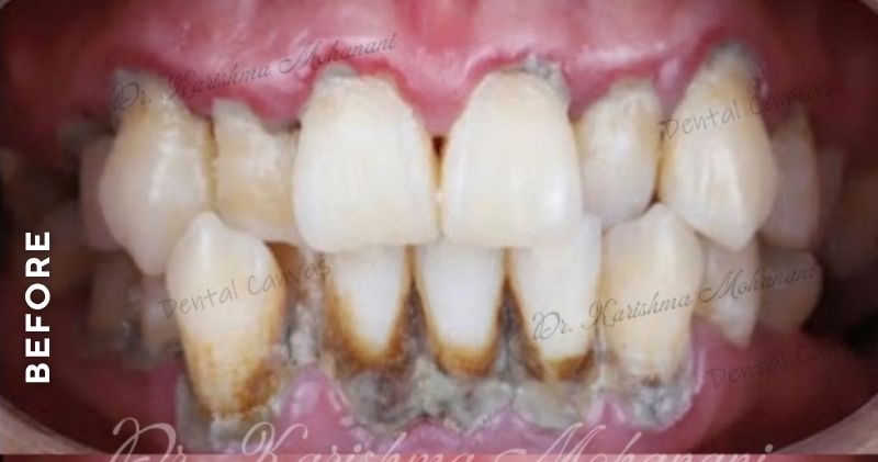 Teeth-Cleaning2-before