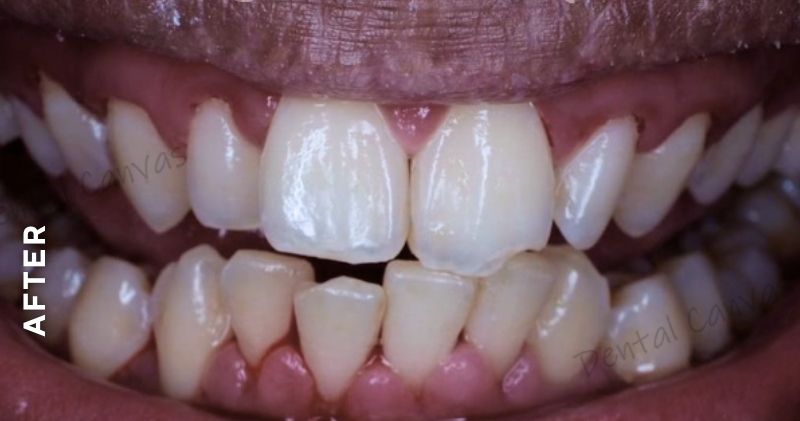 Teeth-Cleaning3-after