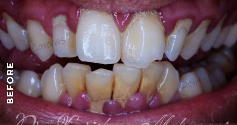 Teeth-Cleaning3-before