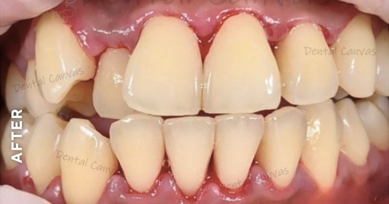 Teeth-Cleaning-after