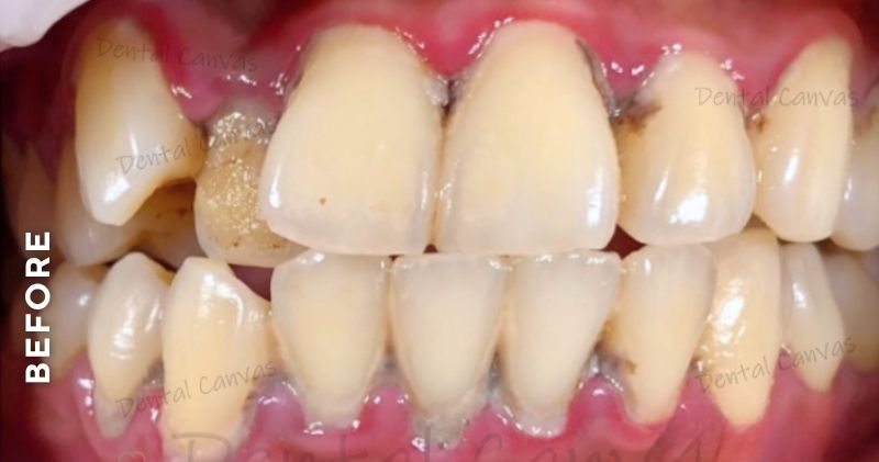 Teeth-Cleaning-before