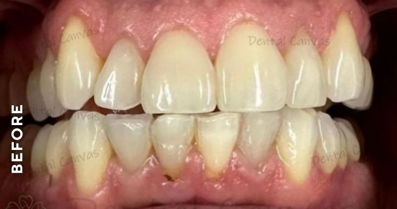 Teeth-Whitening-before