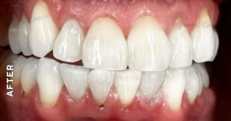 Teeth-whitening-after