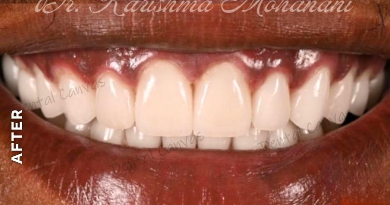 Dental-Veneers-after