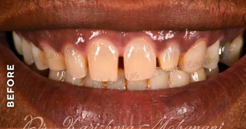 Dental-Veneers-before