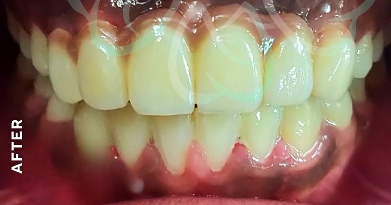 Missing Teeth Replacement
