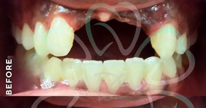 Missing Teeth Replacement