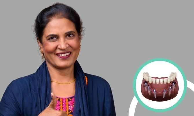 All-on-4 & All-on-6 Dental Implants In Marathahalli Bangalore