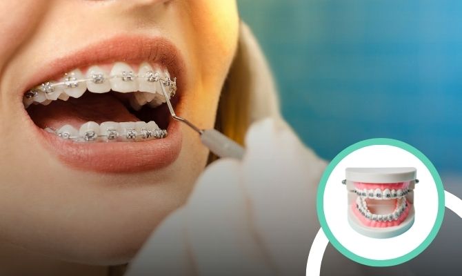 Braces TreatmentIn Marathahalli Bangalore
