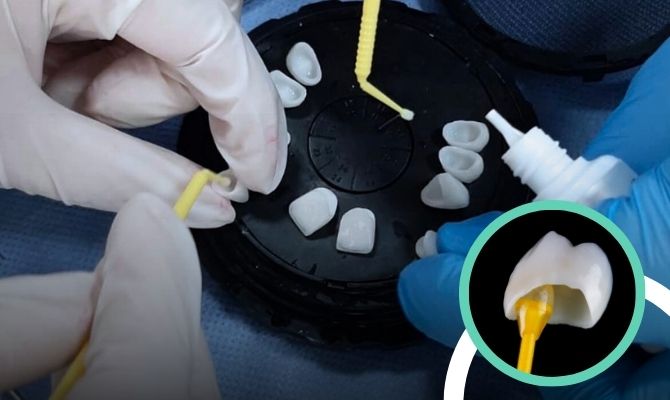 Dental Crowns & Bridges In Marathahalli Bangalore