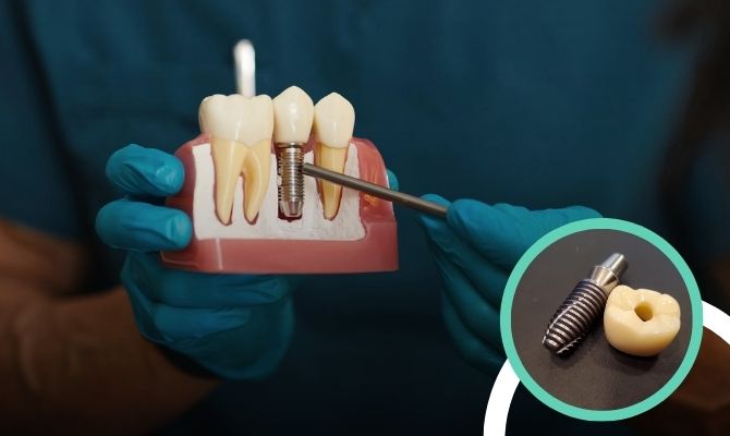 Dental ImplantsIn Marathahalli Bangalore