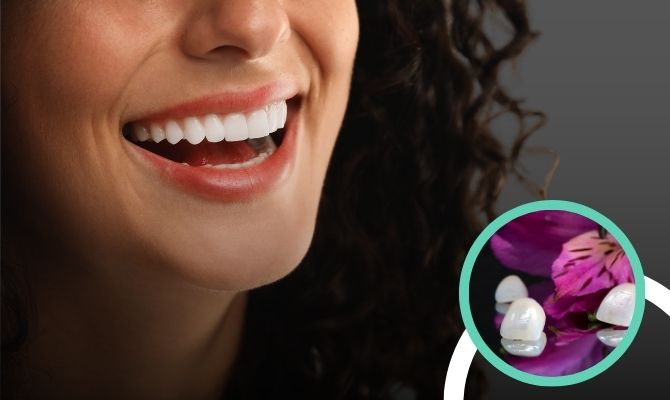 Veneers and Laminates In Marathahalli Bangalore