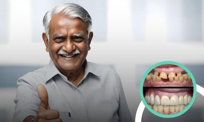 Full Mouth Rehabilitation In Marathahalli Bangalore