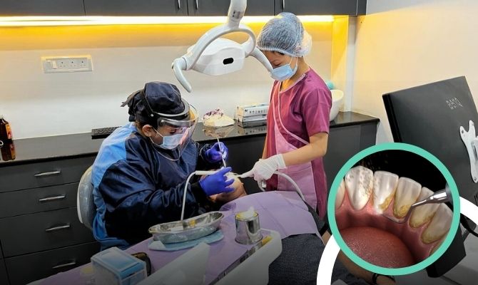 Teeth Cleaning In Marathahalli Bangalore